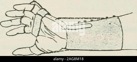 . Terapia medico-chirurgica. Fig. 37.-Apparecchio per permanente muscolo-spirale paralisi seenfrom la superficie superiore. (Froment e Muller,) punto fisso nell'apparecchiatura che si opporrà itstendency a goccia, anche durante lo sforzo e quando theobject afferrato è pesante. * Può essere una molla di estensori di alimentare tale desideratum ?Per questo dobbiamo rispondere in senso negativo. . In tal modo. Fig. 38.-Lo stesso visto dalla superficie inferiore. è stato riscontrato che alcuni operai prendono off theirappliance a lavorare. In opposizione distinti per gli apparecchi progettati conla oggetto della ri-educare le parti, abbiamo qui tosupplement sp Foto Stock