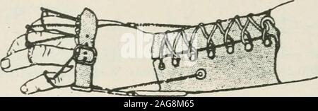 . Terapia medico-chirurgica. Fig. 36.-Apparecchio per la correzione dei disturbi muscolo-spirale paralisi(vista frontale). 38) è di un analogo del design ma può essere bloccato, thehand rimanendo leggermente hyperextended per consentire heavyobjects per essere afferrata; è un buon apparato forworking con.^ 0ther ugualmente pratico apparecchi sono quelli ofPrivat e Belot (figg. 39 e 40), Leri e Dagnan-Bouveret (fig. 41), Mouchet e Anceau, Rieffel andRipert. La Commissione ha nominato dal 1 neurologiche Bevue Neurologiqucy Luglio 1916, p. 123, 336 di trattamento e la riparazione delle lesioni nervose Società a indagare protesico per appl Foto Stock
