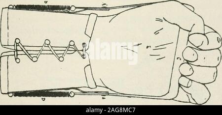 . Terapia medico-chirurgica. Fig. 35.-Apparecchio per la correzione dei disturbi muscolo-spirale paralisi(appliance a riposo). (A. Souques, M6gevand e Donnet.) i movimenti di flessione su base volontaria e meccanica ex-tensione può quindi avvenire liberamente (figg. 35 e 36).L'apparecchio di Froment e Muller (figg. 37 e. Fig. 36.-Apparecchio per la correzione dei disturbi muscolo-spirale paralisi(vista frontale). 38) è di un analogo del design ma può essere bloccato, thehand rimanendo leggermente hyperextended per consentire heavyobjects per essere afferrata; è un buon apparato forworking con.^ 0ther ugualmente pratico apparecchi sono quelli ofPrivat Foto Stock