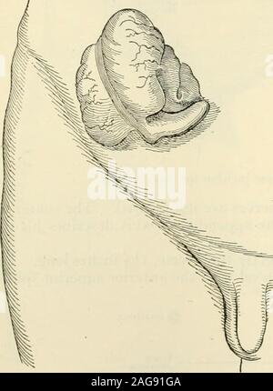 . La moderna chirurgia generale e operativa. Egli ferita. Inmany casi sarà opportuno offrire la testa del colon da thebelly (Fig. 712); in altri casi non sarà necessario, in alcuni willnot essere possibile. Non permettere il appendice a toccare la pelle del theabdomen come in Fig. 712. Se adesioni esistono, esse devono essere dolcemente e carefullyseparated. Metodo di imbonitori (Fig. 713) è un molto soddisfacenti modalità di rimozionedel appendice. È stato fatto come segue: alzare un bracciale del peritoneo, tirare giù altre cappotti, legare alla base, tagliare attraverso il tubo, lasciate che la retrazione musculomucousstump, e ti Foto Stock