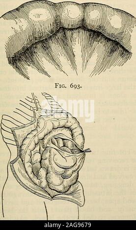 . La moderna chirurgia generale e operativa. Fig. 689. Fig. 690.. Foto Stock