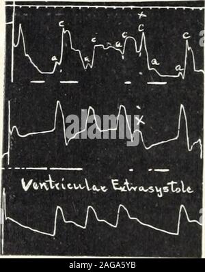. Medico americano. Fig. s figg. 4 e 5. Il blocco cardiaco completo.-sviluppo dopo digipuratumgr. iss ti.d. per nove giorni. Tracing 5 mostra ritorno al ritmo normale a valledel effetto digitalico aveva indossato off. 6i8 il medico americano l;h, i /VAx ho Vtlvtau-u-lo-t E*tx^=lj stole ui,LsvusTri""v" cyout-s Fig. 7. [3 Y 0 O ItqC rt- C-! - Fyjiic Foto Stock