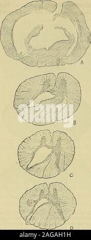 . Un manuale di malattie del sistema nervoso. * Per la possibilità di disegnare queste sezioni sono grata al Dr, Dreschfeld.un account completo del caso è stato pubblicato dal dottor Harris nel cervello, Gennaio 1886.I grandi crescite sono state sarcomata. 570 il midollo spinale.. ed il tessuto circostante è moreabundant, ma facilmente distinguere in grado dalla sostanza grigia,mentre un po' più in basso thecavity scomparso e thetissue formata una compatta roundedmass. La cavità è rivestita da uno strato adelicate di cellulari mem brane-: al di fuori di questo è un fibrousmembrane, giacente in pieghe whichappear come sinuosities in lasezione. Foto Stock