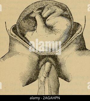 . Domande e risposte su essentials di ostetricia; preparati specialmente per gli studenti di medicina. Il handpresses esterno della testa del feto verso il fondo dell'utero.Se un ginocchio non può essere raggiunto, fare pressione su una certa porzione della culatta, o gancio un dito nella piega della coscia e bacino bringthe verso il basso. Quali sono le condizioni necessarie per la versione da theinternal metodo ? 1. La cervice deve essere dilatata. 2. La parte presentata non dovrebbe essere diventata fissa. 3. Il bacino deve essere sufficientemente grande da consentire il feto a bedelivered dopo la rotazione. Operazioni di ostetricia. 197 Descr Foto Stock