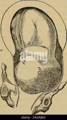 . Domande e risposte su essentials di ostetricia; preparati specialmente per gli studenti di medicina. Durante un normale lavoro,è situato su un livello con l'ingresso pelvico. Supponiamo ora, insteadof la resistenza normale a far avanzare la presentazione, uno orother delle condizioni necessarie per la rottura di verificarsi esiste; wewill hanno quindi la elForts uterina aumentata e il contrac tion ring sarà ritirata verso l'alto fino a quando non raggiunge la thepubes sopra o in prossimità dell'ombelico. Così, il lowersegment dell'utero sarà fortemente assottigliata e stirata, mentreil fundus sarà addensato. Foto Stock