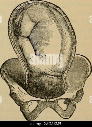 . Domande e risposte su essentials di ostetricia; preparati specialmente per gli studenti di medicina o di angolo leviti osso occipitale. La manodopera. 115 R. O. P., in superior e angolo anteriore dell'osso leftoccipital.faccia.-fronto-posizioni anteriore, sulla porzione superiore della regione themalar, e in alcuni casi, sull'occhio.fronto-posizioni posteriori, sulla porzione superiore della regione themalar che sul lato della bocca.culatta.-Come una regola su nella parte anteriore della coscia; può anche includere i genitali esterni.spalla. Dopo la presentazione di spalla. Meccanismo di manodopera. Che cosa si intende per Foto Stock