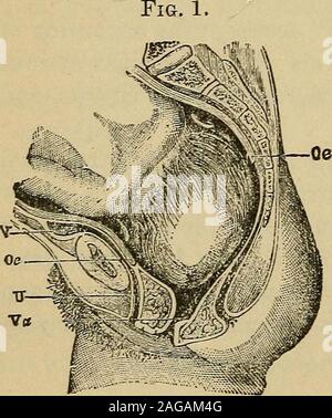 . Domande e risposte su essentials di ostetricia; preparati specialmente per gli studenti di medicina del lavoro UE-dolori? Vero dolori.i sintomi premonitori del lavoro.iniziare nel lombo-sacrale, ri-gion e si estendono alla pubes.regolari nella reiterazione.aumento della gravità.la dilatazione della cervice.Eflfacement del collo. Falso dolori.No i sintomi premonitori.sentito a tutte le parti della abdo-uomini.irregolare. Nessun aumento di gravità.Nessuna dilatazione.No effacement. Che cosa si intende per i fenomeni plastici del lavoro ? La forma del feto-modifiche prodotte in lavoro e dependentupon la presentazione e la posizione (Parvin). La a Foto Stock