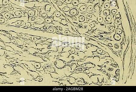 . Un manuale di malattie del sistema nervoso. ;^ è -^-^ &gt;0 P. Fig. 59.-Più nevriti di origine alcolica : sezioni colorate con carmine e cancellate.A. La sezione trasversale di una parte del nervo sciatico; bassa potenza, b. Parte di un Fas-ciculus della stessa, più fortemente ingrandita, c. Parte di un meno influenzato fasciculusfrom un muscolo-spirale del nervo. Foto Stock