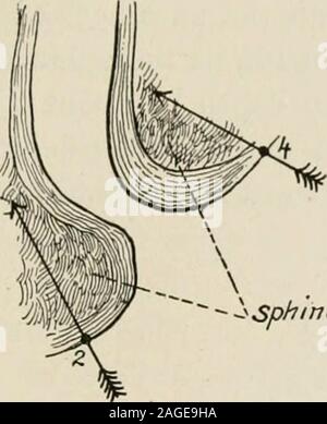 . Gli enti locali e regionali; anestesia con capitoli su spinale, epidurale, paravertebral e parasacral analgesia e altre applicazioni locali e regionali di anestesia per la chirurgia dell'occhio, orecchio, naso e gola e per studio dentistico. 1. v;- 5 1 ig. n°-Metiiod di rendere profondo perirectal iniezioni. GENITO-urinario, anorettali, E OPERAZIONI GINECOLOGICA 415 proteggere accuratamente l'ano contro qualsiasi contatto con l'azienda sprayby una spugna di garza ben contro di essa.. Foto Stock