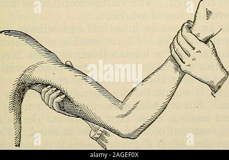 . La moderna chirurgia generale e operativa. - Imbottito. dovrebbe essere dall'interno outw^ard (Fig. 254); nella parte inferiore, da prima di back-ward (Fig. 255). L'aorta addominale può essere compresso da Macewensmethod (q. v.). Iliaca comune può essere compressa attraverso il retto damezzi di un tondo di w^ood noto come leva Davys. Il componente femorale arterycan essere compressa appena al di sotto del legamento Pouparts contro il psoas muscleand testa del femore (Fig. 256). La pressione dovrebbe essere direttamente backw^ard.nel terzo medio della coscia la compressione digitale è insoddisfacente e atourniquet dovrebbe sempre essere utilizzata o Foto Stock