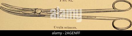 . Un manuale delle malattie del naso e della gola. forse così a lungo che il bordo inferiore dell'ugola può soltantoessere portato in vista per il passaggio di un gancio dietro di esso anddragging in avanti in bocca. L'ex inferiore tremity è atta ad essere ampliato e bulboso. Il trattamento. Trattamento palliativo, come l'uso ofastringent spray, è di scarsa utilità in elonga cronica- allungamento cronica dell'ugola. 301 zione. L'ugola dovrebbe essere asportato. Si deve anzitutto bepainted con un dieci per cento, soluzione di cocaina e in corrispondenza della estremità di cinque minuti la uvulotome o ugola forbici(Fig. 81) dovrebbe essere inserito nella bocca, th Foto Stock