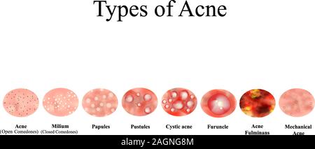 Tipi di acne infiammazione della pelle. Brufoli, bolle, Whitehead, comedoni chiusi, papule, pustole, acne cistica. Infographics. Illustrazione Vettoriale su Illustrazione Vettoriale