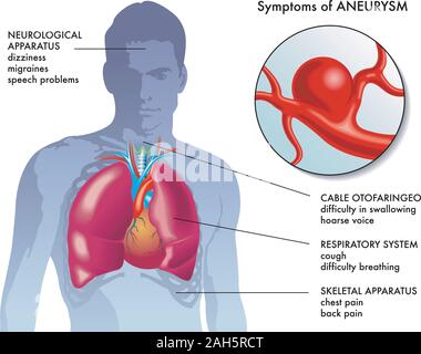 Illustrazione medica dei principali sintomi di aneurisma. Illustrazione Vettoriale