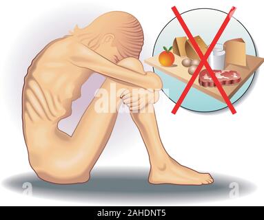 Emblematica Illustrazione medica del disturbo alimentare chiamato anoressia. Illustrazione Vettoriale