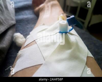Periferiche catetere venoso nella vena della mano umana. Foto Stock