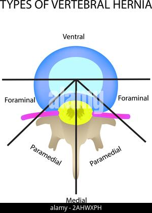 Tipi di ubicazione dell'ernia intervertebrale. Illustrazione Vettoriale su sfondo isolato. Illustrazione Vettoriale