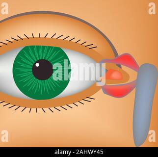 Canaliculitis. Infiammazione dei canali lacrimali. La struttura dell'occhio. Infographics. Illustrazione Vettoriale. Illustrazione Vettoriale