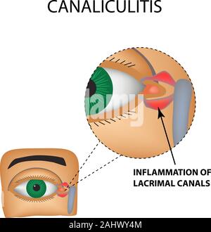 Canaliculitis. Infiammazione dei canali lacrimali. La struttura dell'occhio. Infographics. Illustrazione Vettoriale su sfondo isolato Illustrazione Vettoriale