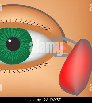 Dacryocyst. Infiammazione del sacco lacrimale dell'occhio. La struttura dell'occhio. Infographics. Illustrazione Vettoriale Illustrazione Vettoriale