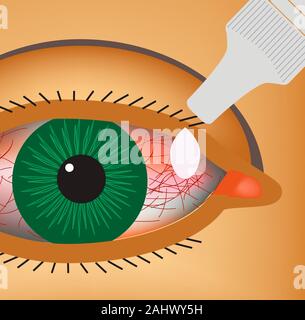 Congiuntivite. Il rossore e infiammazione dell'occhio. Le navi. Gocce per gli occhi. Infographics. Illustrazione Vettoriale. Illustrazione Vettoriale