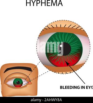 Hyphema. Anteriore emorragia oculare. La struttura dell'occhio. Infographics. Illustrazione Vettoriale su sfondo isolato Illustrazione Vettoriale