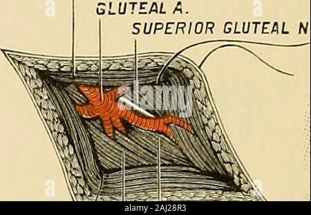 Intervento chirurgico . Gluteo M.UTEALA.GLUTEO SUPERIOR n. r] GLUICVS MEDIUS MPYRIFORMIS M. Foto Stock