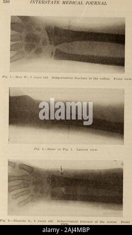Interstate medical journal . ost prominentones. In casi gravi, ci sono in aggiunta a quanto sopra, de-formity, crepitus e falsa la mobilità. La deformazione è stata così markedin uno dei nostri casi, che somigliava al silver deformità delle forche,comunemente visto in Colles frattura nell'adulto (caso II, Fig. 4).L'crepitus come una regola è molto morbido e non somiglia a quella usuallyfound in fratture. Tre di questi casi sono state complicate dalla infrazione dell'ulna.I sintomi derivanti dall'infrazione erano molto mite. Figg. 4 e 5 sono immagini a raggi x di epiphyseal separazione di theradius. La seguente Foto Stock