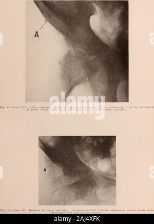 Interstate medical journal . Figura 13.-caso VI. Fotografie prima dell'operazione. Radiografie prima e dopo il funzionamento dal metodo aperto. Allison e Dixon: congenita di lussazione dell'anca. Allison e Dixon: dislocazione congenita di Hip Foto Stock