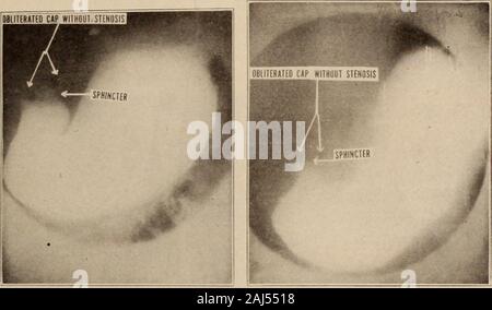 Interstate medical journal . mostrato exacerba occasionali-zioni quando egli non era del tutto libera dal dolore, ma i sintomi sono neverbeen sufficientemente gravi da giustificare un intervento chirurgico. Caso XXI. (Fig. 21.) Storia clinica: non ottenuta. Roentgen diagnosis: due esami sono stati fatti di questo paziente. Il firstshowed un attivo della peristalsi ostruito al fine pilorica e un irregularcap e sfintere. Il secondo ha mostrato la peristalsi molto più attiva della Interstate Medical Journal 41 il primo e una irregolarità di maggiore curvatura. Probabilmente alla pointof un gastroenterostomy, ma con Foto Stock