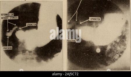 Interstate medical journal . Fig. 14.-mostra cicatrix di ulcera guarita. Caso XV. (Fig. 15.) INTERSTATE MEDICAL JOURNAL 39 caso XVI. (Fig. 16.)storia clinica: i sintomi iniziali si fosse verificato venti anni pre-cedenza, ma erano stati notevolmente aggravata durante i precedenti tre anni orfour. I suoi attacchi sono stati segnati da forti dolori nella parte sinistra e oc-sionally nella parte inferiore dell'addome. I sintomi erano esentate dal cibo. Hesuffered violenti attacchi di vomito e dolore, che sono stati sollevati bypressure. Roentgen diagnosis: prove di un'ulcera sulla superficie superiore del iltappo del foro. La successiva h Foto Stock