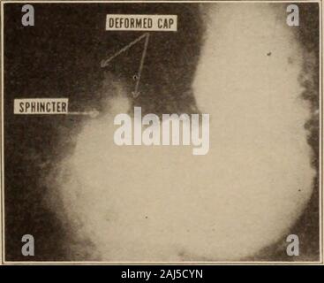 Interstate medical journal . • 1 Uj;ii:ihih ^ 1 Caso IX. (Fig. 9.) La storia clinica: gran parte esauriti da diverse operazioni; presente symptomswere dolore costante nella regione del fegato e della cistifellea, con eruttazioni,il rigurgito e nausea, che non aveva alcuna relazione a mangiare. Roentgen diagnosis: al momento dell'esame iniziale che wasone dei precedenti casi esaminati da questo metodo, la natura esatta della thelesion non è stato riconosciuto. Una successiva restudy delle tavole originali in thelight di conoscenza aggiunto rivela chiaramente un segno inconfondibile di post-ulcera pilorica. La successiva hi Foto Stock