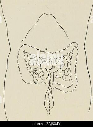 Trattamento chirurgico; una pratica trattato sulla terapia delle malattie chirurgico per l'uso di professionisti e studenti di chirurgia . Fig. 1353--Esclusione intestinale da Ileosigmoidostomy e occlusione di IleumDistal per la anastomosi. testinal canal. In unilaterale e bilaterale di esclusione, gli esclusi endsshould essere portato fuori come fistole intestinali per il drenaggio. Eccezioni 680 il trattamento chirurgico. Fig. 1354.-Esclusione intestinale da Ileosigmoid estremità-lato anastomosi. Il moncone dell'ileo è fissata in un pulsante di ferita del foro nella parete addominale. A. Tubo di drenaggio viene fatto passare attraverso il retto abov Foto Stock