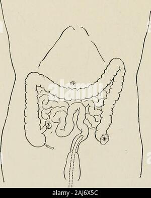 Trattamento chirurgico; una pratica trattato sulla terapia delle malattie chirurgico per l'uso di professionisti e studenti di chirurgia . Fig. 1354.-Esclusione intestinale da Ileosigmoid estremità-lato anastomosi. Il moncone dell'ileo è fissata in un pulsante di ferita del foro nella parete addominale. A. Tubo di drenaggio viene fatto passare attraverso il retto al di sopra della anastomosi.. Fig. 1355.-Esclusione intestinale da Ileosigmoidostomy.il moncone di ileo e della sigmoide sono attaccati in corrispondenza di aperture ihjthe abdominalwall. Un tubo è collocato nel retto al di sopra della anastomosi. Questo è l^best oftheseprocedures. L'ADDOME 681 Foto Stock