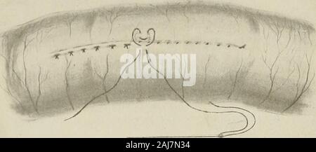 Trattamento chirurgico; una pratica trattato sulla terapia delle malattie chirurgico per l'uso di professionisti e studenti di chirurgia . Fig. 1283.-ad angolo retto del materasso Stitch di Halsted.La sutura primario è stato applicato. Fig. 1289.-Infolding ad angolo retto del materasso di sutura Gould.La sutura primaria è stata applicata. Foto Stock