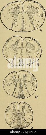 Un manuale di malattie del sistema nervoso . Fig. 73a.-degenerazione di theantero-laterale tratto ascendente iua caso di locouiotor ataxy (q. v,la figura), che mostra la sua posizione superiore nella regione cervicale, wherethe diretto tratto cerebellare passesoutside nel corpo restiform.. Fig- 74-degene ascendente-razione nel po^tciO-...ediancolumn e antero-lateralascending tratto. Il cavo?era cruslied al primo lum-bar segmento. Foto Stock