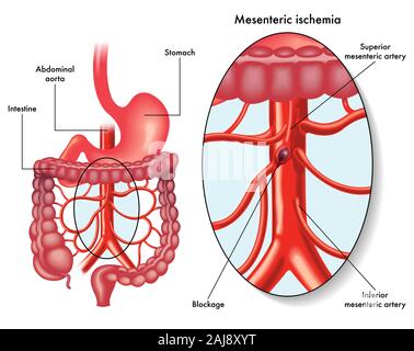 Illustrazione che mostra una ischemia mesenterica anche chiamato infarto intestinale, un blocco della circolazione del sangue, che incidono sulla arteria mesenterica Foto Stock