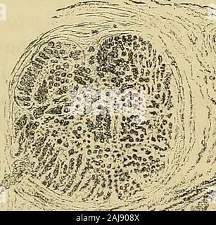 Un manuale di malattie del sistema nervoso . Fig. 59.-Più nevriti di origine alcolica : sezioni colorate con carmine e cancellate.A. Sezione trasversale di p irt del nervo sciatico; bassa potenza, b. Parte di un Fas-ciculus della stessa, più liiahly ingrandita, c. Piirt di meno influenzato fasciculusfrom un muscolo-spirale nervo.. r^^^ I ( B Foto Stock