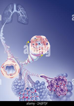 Malattia polmonare ostruttiva cronica, COPD Foto Stock