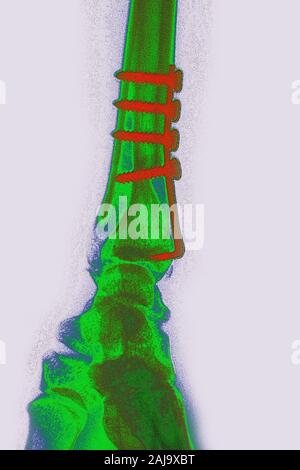 Osteosintesi su radius Foto Stock