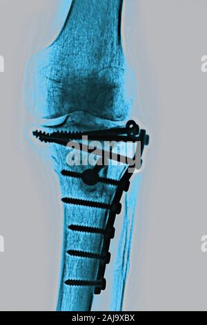Osteosintesi sulla tibia Foto Stock