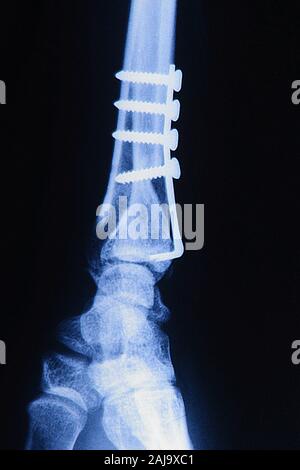 Osteosintesi su radius Foto Stock