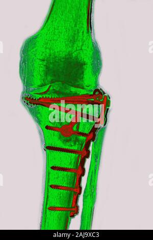 Osteosintesi sulla tibia Foto Stock