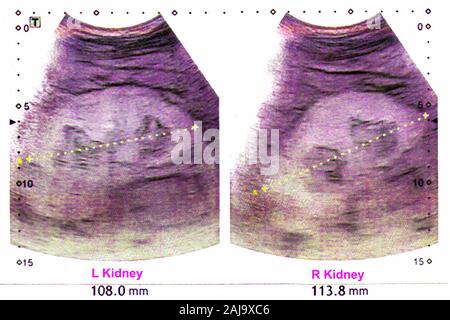 Ultrasuoni Kidneus Foto Stock