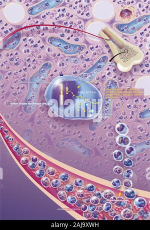 Cronica leucemia mieloide, CML Foto Stock