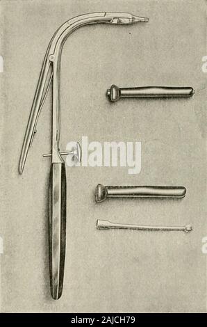 Trattamento chirurgico; una pratica trattato sulla terapia delle malattie chirurgico per l'uso di professionisti e studenti di chirurgia . , O nel caso in cui il tubo è troppo piccolo e scivola attraverso la laringe. Molte modifiche e alcuni miglioramenti dell'ODwyer instrumentshave stata fatta. Forse la migliore di queste sono quelle di Max Thorner.Questi strumenti sono più semplici rispetto a quelli di ODwyer. I tubi hanno 238 5 CHIRURGICO TREA TMEN T'apertura superiore ad imbuto e l'estremità inferiore obliquo. L?erterand estrattore sono combinati in un unico e semplice strumento. La tecnica di intubazione è semplice. No anesthe Foto Stock