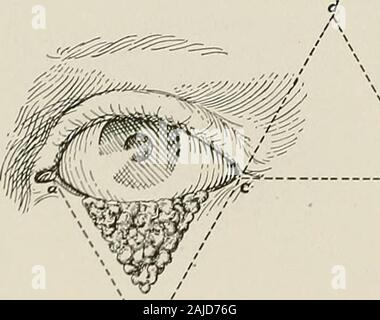 Trattamento chirurgico; una pratica trattato sulla terapia delle malattie chirurgico per l'uso di professionisti e studenti di chirurgia . Fig, 798.-della Blefaroplastica. Quarta fase. Lembo cucito in posto e chiusura della ferita. Foto Stock