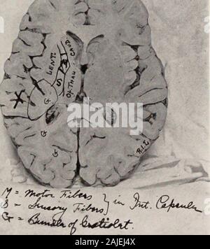 Ufficiale di oftalmologia, otology e laryngology . h pass thru verso l'alto il discorso per la zona del centro di grafica. Se unadelle le arterie sono state thrombosed in basso, la fornitura di entrambi areaswould essere compromessa o associazione di fibre tagliate. Caso 2.-La Sig.ra B., aprile 1906, aveva coma uremico di gravidanza.Dopo il coma aveva superato, visione era molto scadente, vi è stata hemi-anestesia, emiplegia e parola di cecità. Ci sono state gravi al-buminuric retinite e destra hemiopia omonima. Ella era unableto dare un nome ad oggetti familiari o numeri; né poteva recollectthe numero di casa sua, ecc. Il hemiane.sthesia Foto Stock