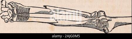 La famiglia americana medico : o, domestici guida per la salute : per l'uso dei medici, le famiglie, le piantagioni, navi, viaggiatori, ecc. . E nessun movimento di esso deve essere tentata per tre settimane orfour. Frattura del FOREAM. Ci sono due ossa nell'avambraccio, uno chiamato ulna, che passesalong il lato interno del braccio che si estende dal punto del gomito,(in cui si forma il processo olecranon,) a quella parte del polso al rootof il dito mignolo; l'altra è la più breve e più piccolo osso, e iscalled il raggio. Una o entrambe di queste ossa può essere rotto al sametime. Quando b Foto Stock