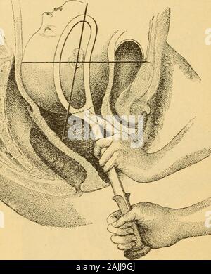Un manuale pratico di ostetricia . Trazione con asse-pinza di trazione. dopo la cura e competenza dell'operatore. Essa è naturalmente morefavorable, altre cose pari, nella proporzione in cui la testa è lowin il bacino. Forcipi in faccia le presentazioni.-Quando la faccia è nellaparte inferiore stretto e il mento ha ruotato per il pubes, il funzionamento è semplice e quasi identico a quello descritto forhead casi con l'occipite per pubica. Le lame 258 strumenti, forcipi, ecc. vengono applicati su ciascun lato e, dopo la trazione ha portato thetip del mento ben fuori sotto il pube arch, le maniglie sono Foto Stock