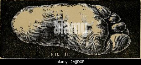 Xix secolo i miracoli, o, alcolici e il loro lavoro in ogni paese della terra : un completo Compendio storico del grande movimento noto come 'moderne spiritualismo' . La cera di paraffina stampo è stato presentato da sul form mentre è ancora sul suo piede a Wm. Oxley, whotook tenere premuto quando il piede è stato instantaneouslywithdrawn. Prodotto di Manchester (Inghilterra)Aprile ennesimo, 1876. Foto Stock